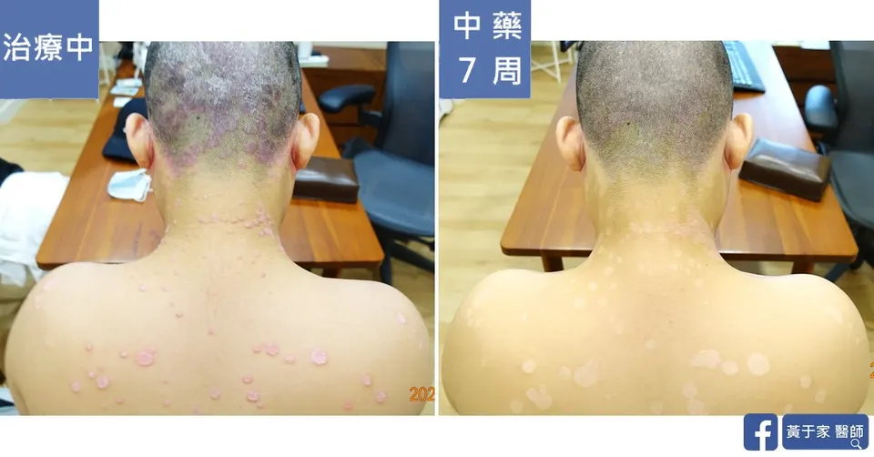 後頸與上背部的比對，左標示「治療中」，右標示「中藥 7 周」