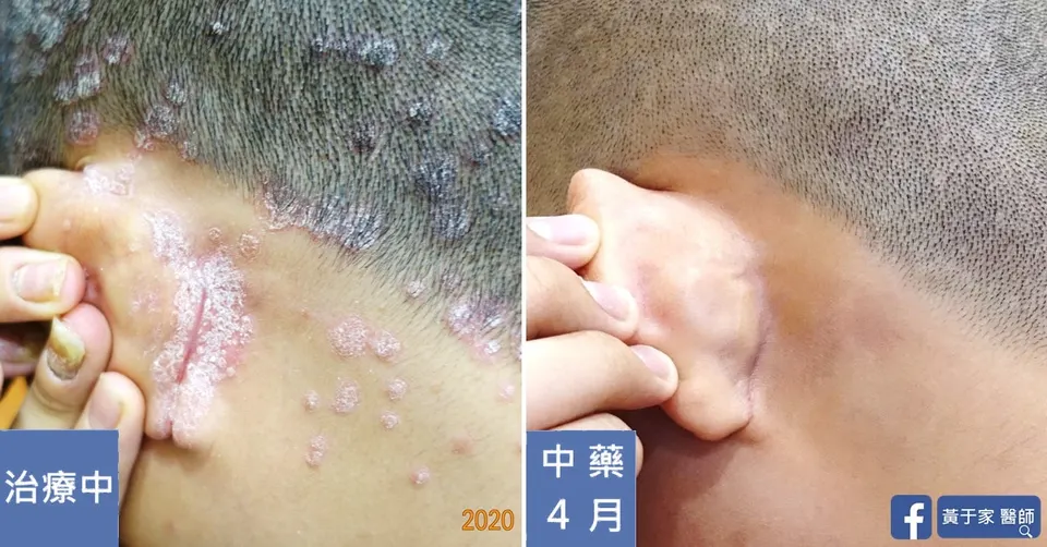 同一位患者右耳後的比對,左標示「治療中」,右標示「中藥 4 月」