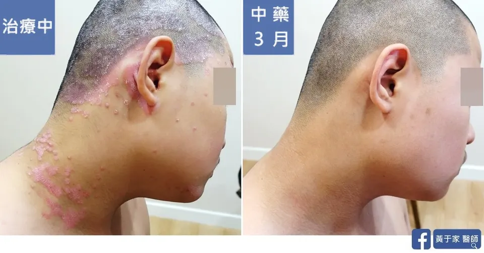同一位患者右側頸部的比對,左標示「治療中」,耳周與頸側散布紅色斑塊;右標示「中藥 3 月」