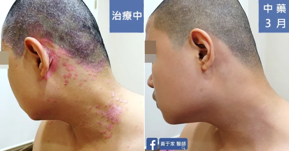 同一位患者左側頸部的比對,左標示「治療中」,右標示「中藥 3 月」