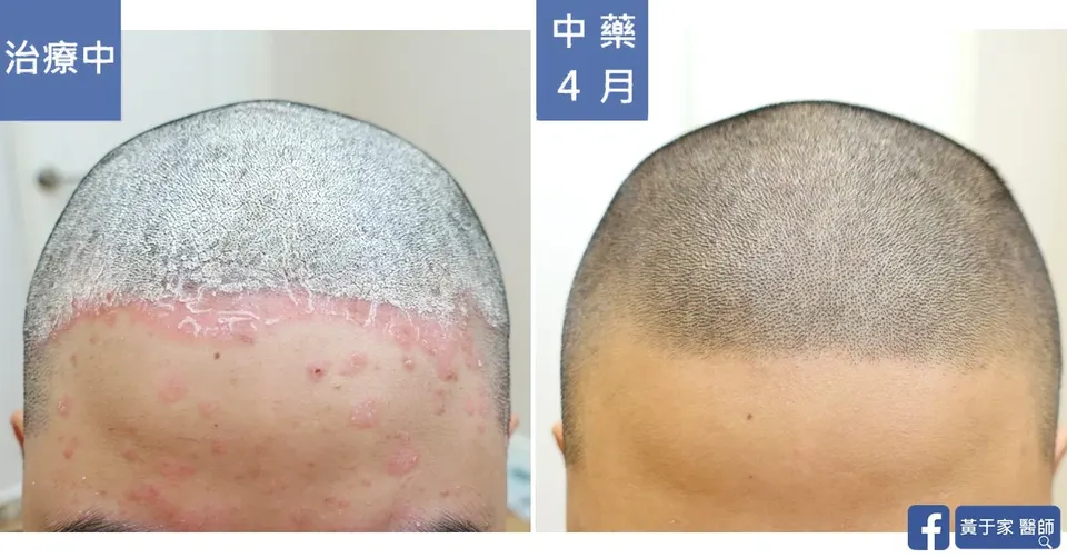 前額髮際的比對，左標示「治療中」，右標示「中藥 4 月」