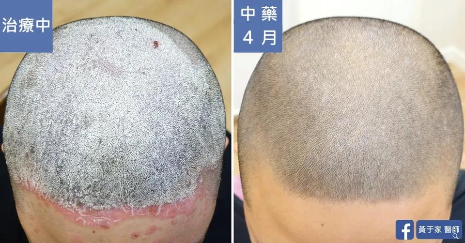 頭頂的比對，左標示「治療中」，右標示「中藥 4 月」