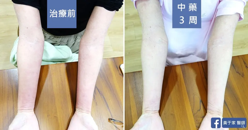 已經成功戒斷，治療前後皮膚外觀比對（2）