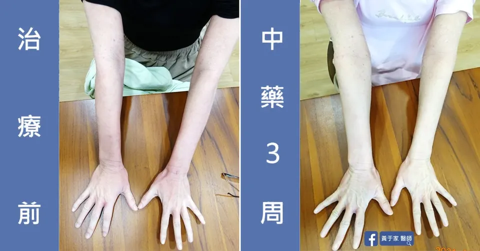 已經成功戒斷，治療前後皮膚外觀比對（3）