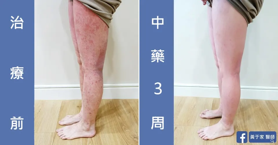 已經成功戒斷，治療前後皮膚外觀比對（4）