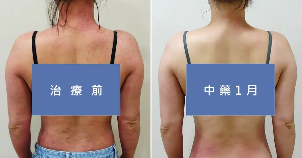長期外擦類固醇，治療前後皮膚外觀比對（2）