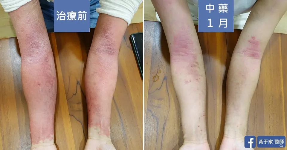長期外擦類固醇，治療前後皮膚外觀比對（3）