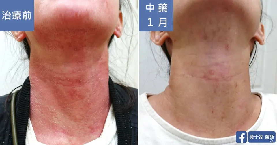 長期外擦類固醇，治療前後皮膚外觀比對（4）