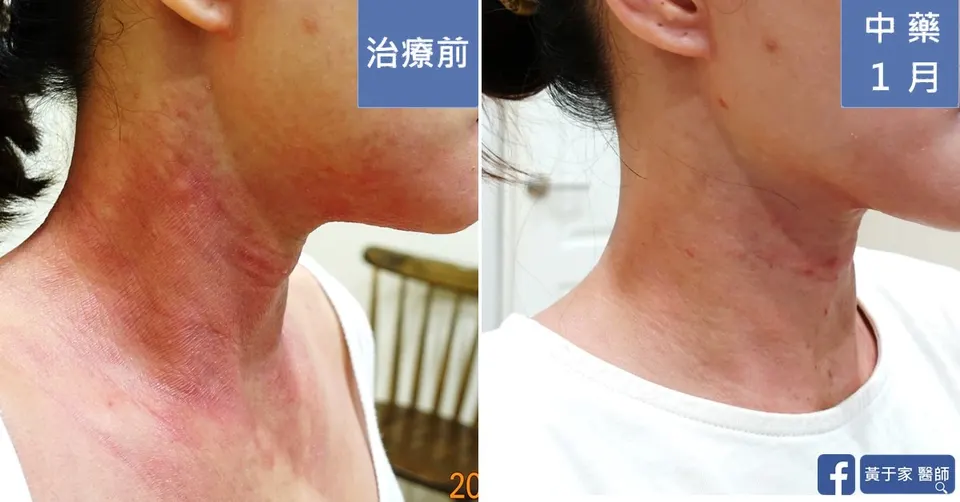 長期外擦類固醇，治療前後皮膚外觀比對（5）