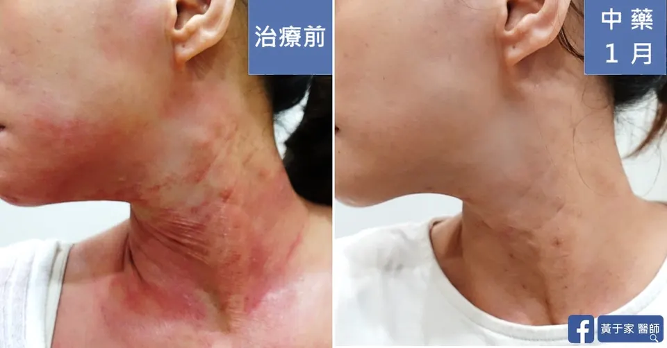 長期外擦類固醇，治療前後皮膚外觀比對（6）