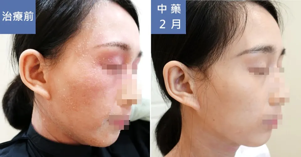 長期外擦類固醇，治療前後皮膚外觀比對（2）