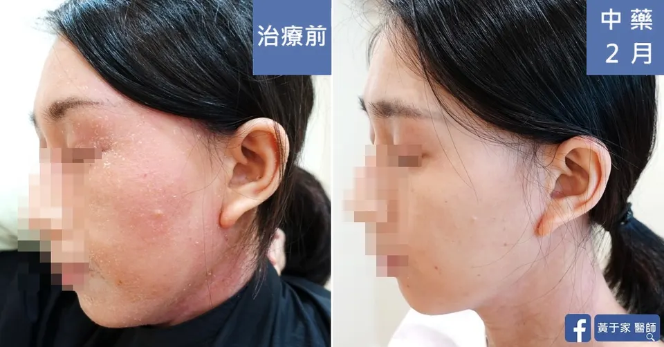 長期外擦類固醇，治療前後皮膚外觀比對（3）