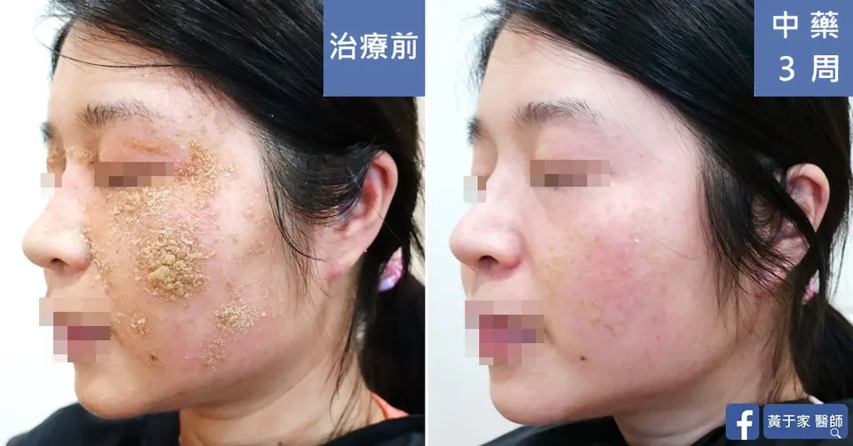 難道就只能靠類固醇和抗組織胺度日嗎？中醫經方 3 周後的變化，治療前後皮膚外觀比對（2）