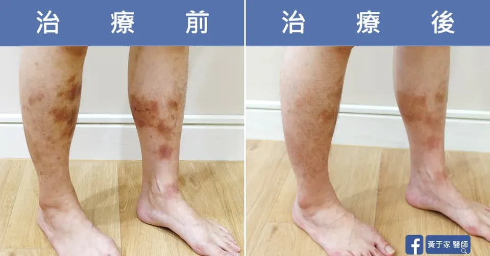 慢性濕疹，治療前後皮膚外觀比對（2）