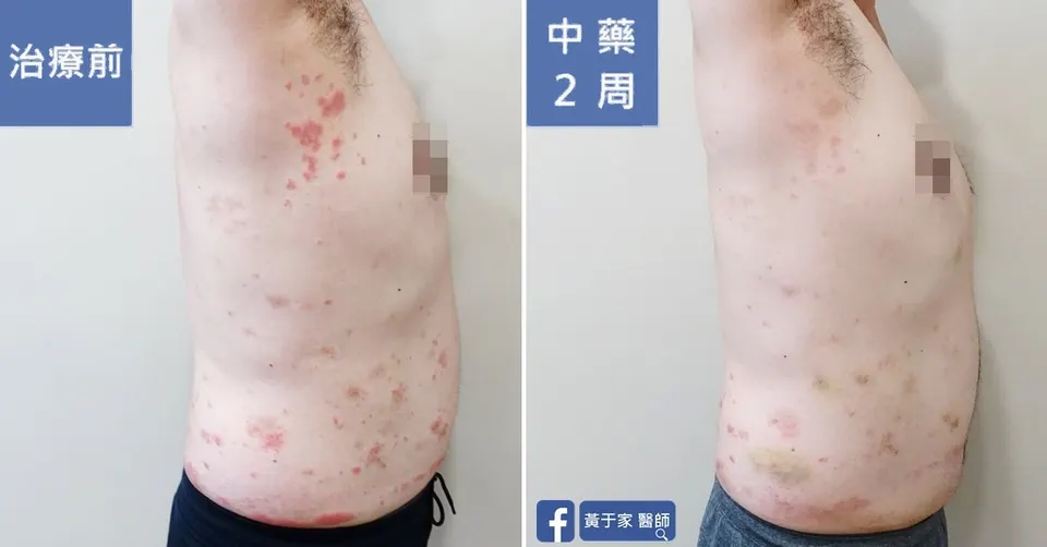 同一位患者左側軀幹的比對，左標示「治療前」，右標示「中藥 2 周」