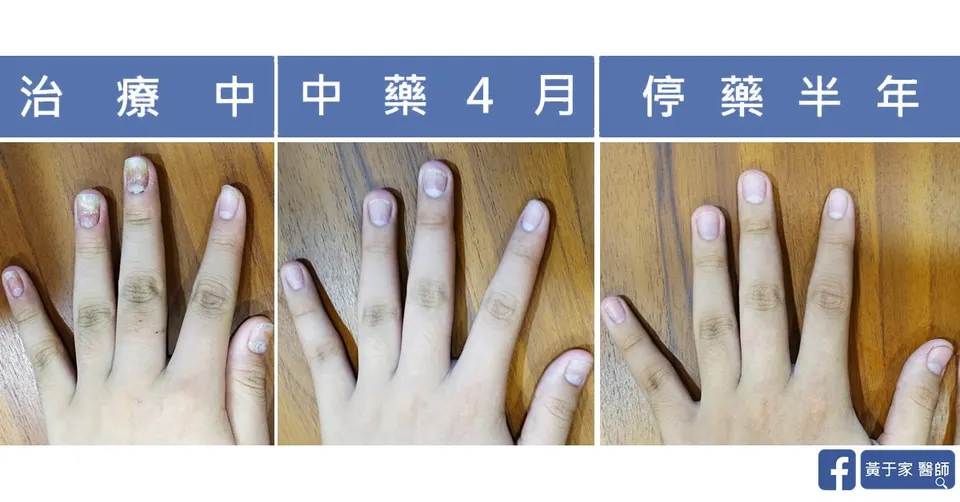 手指指甲三個時間點並排：治療中、中藥 4 月、停藥半年