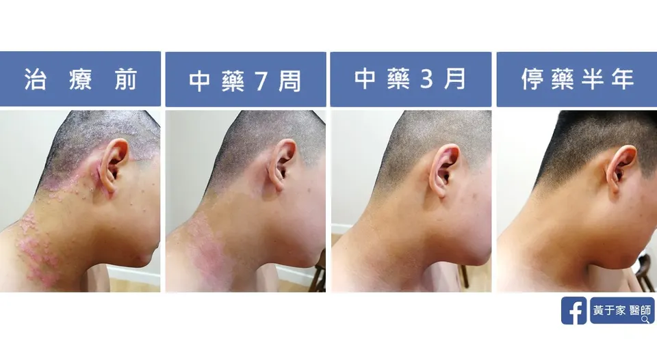 頸部側面四個時間點並排：治療前、中藥 7 周、中藥 3 月、停藥半年