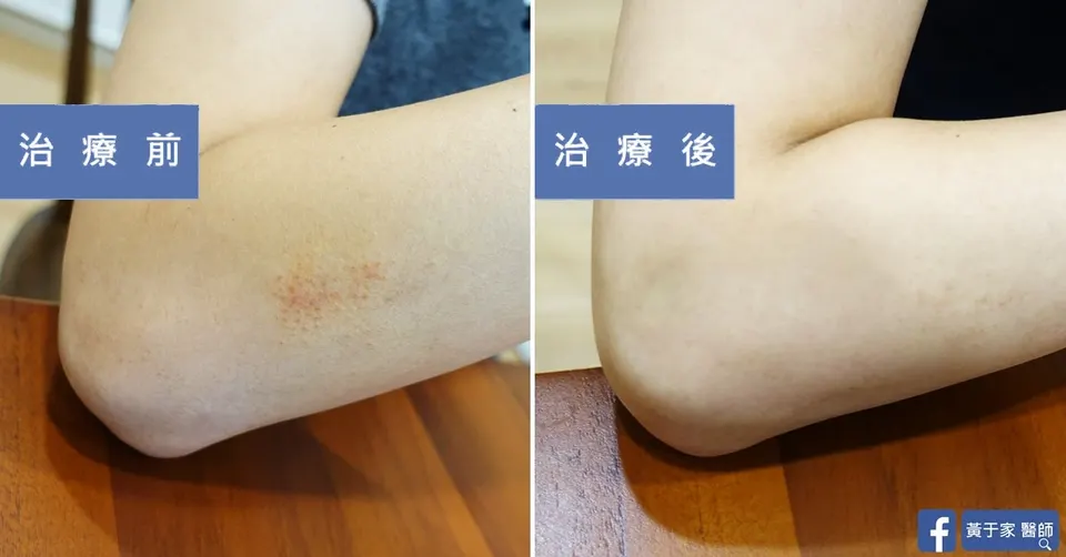 濕疹多年，治療前後皮膚外觀比對（3）