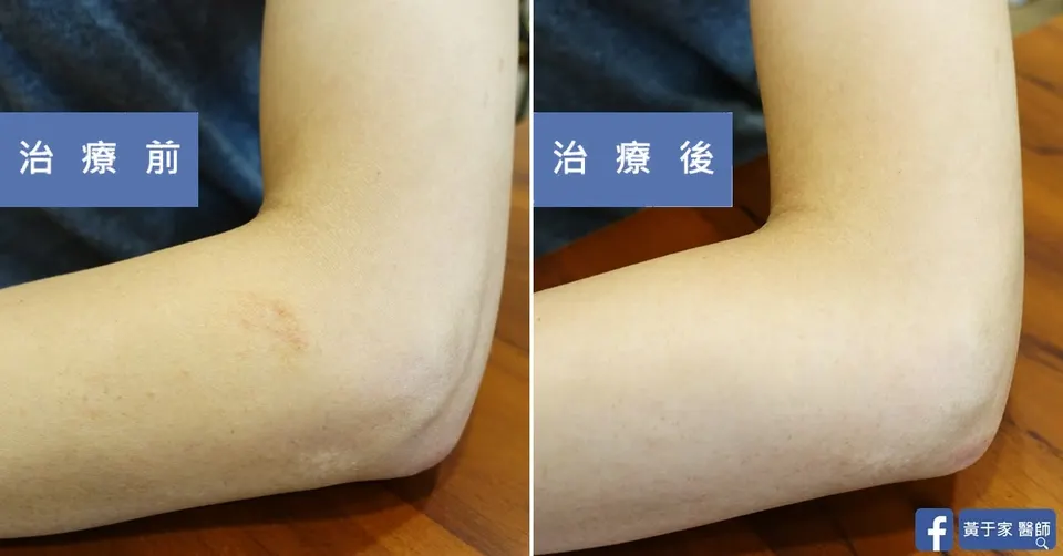 濕疹多年，治療前後皮膚外觀比對（4）