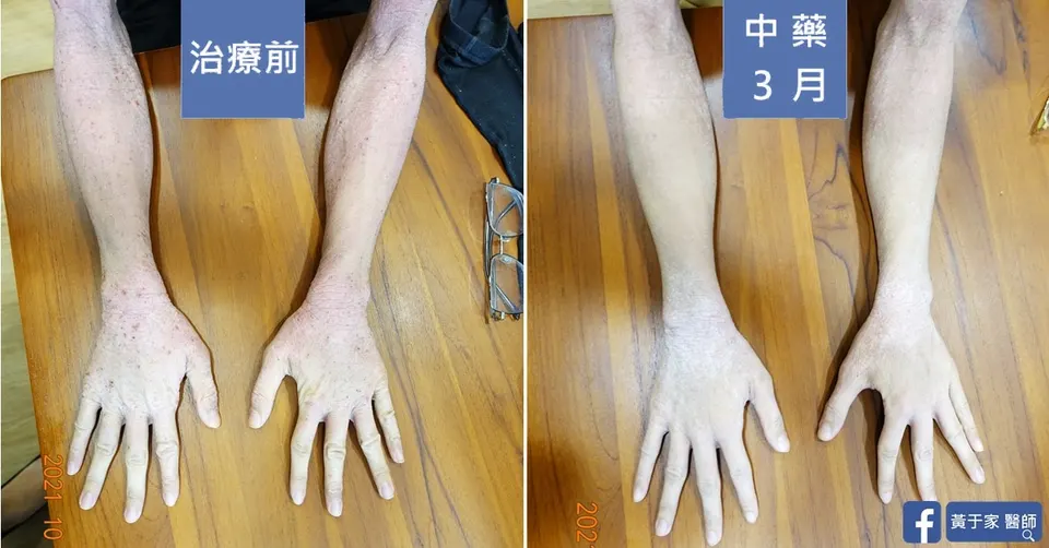 同一位患者雙手前臂與手背的比對，左標示「治療前」，右標示「中藥 3 月」