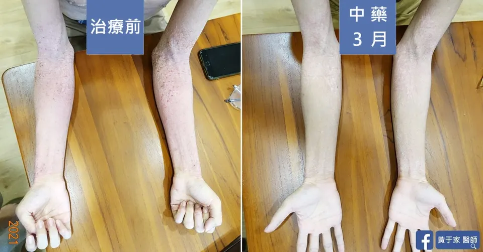 同一位患者前臂內側與手掌的比對，左標示「治療前」皮膚乾燥粗糙，右標示「中藥 3 月」