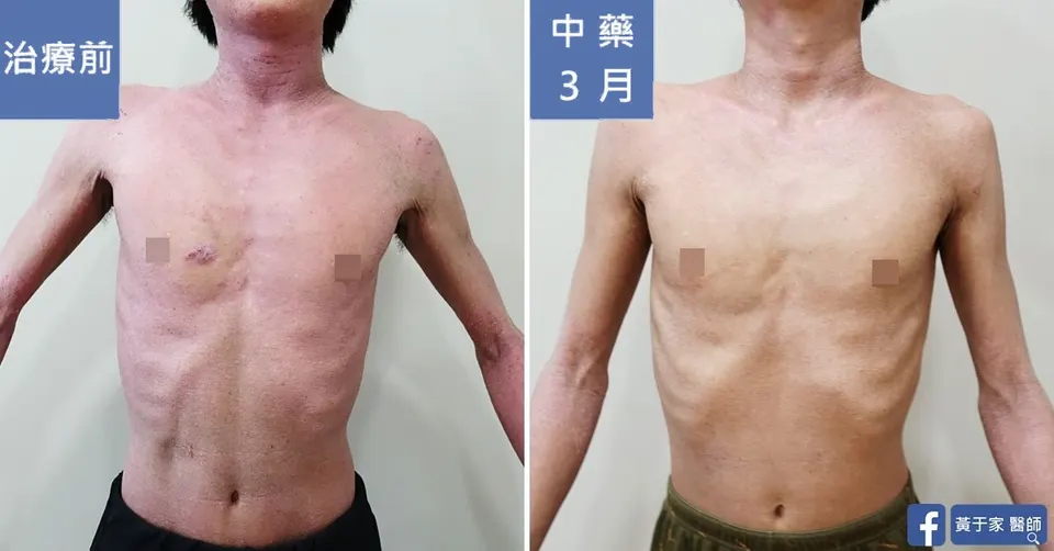 同一位患者胸腹的比對，左標示「治療前」大片泛紅，右標示「中藥 3 月」