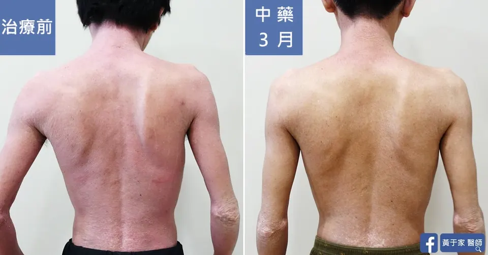 同一位患者背部的比對，左標示「治療前」大片泛紅，右標示「中藥 3 月」
