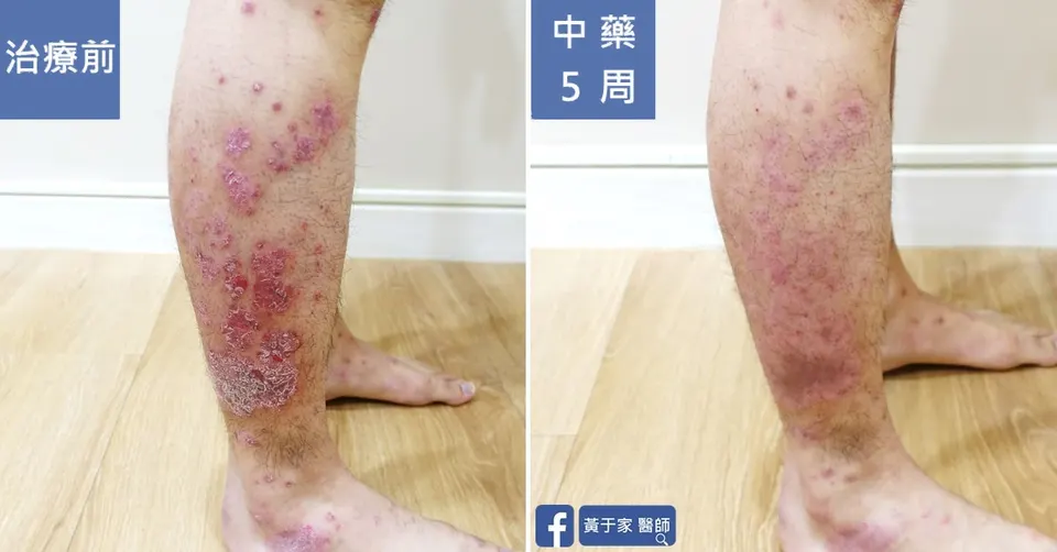 同一位患者小腿外側的比對，左標示「治療前」，右標示「中藥 5 周」