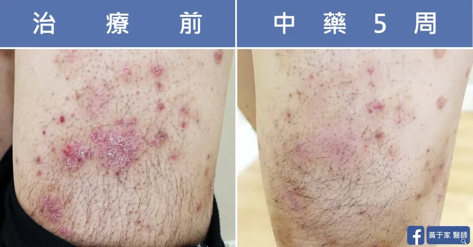同一位患者大腿的比對，左標示「治療前」布滿紅色鱗屑斑塊，右標示「中藥 5 周」