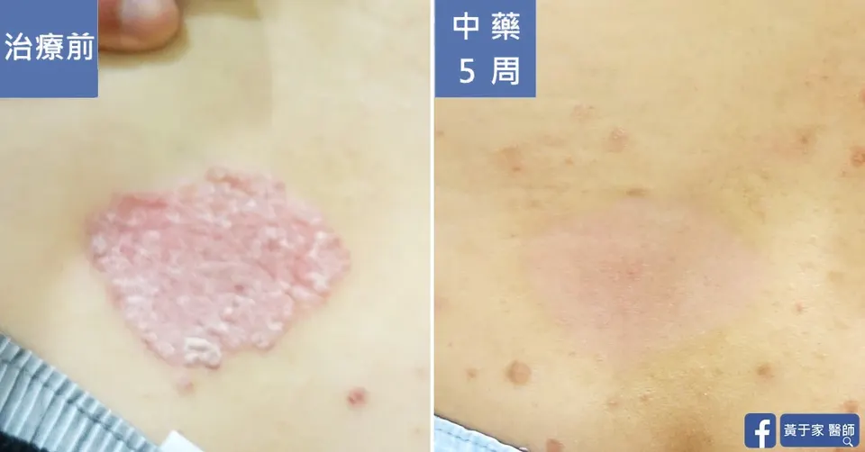 同一位患者腹側一塊斑塊的近照比對，左標示「治療前」厚鱗屑紅斑，右標示「中藥 5 周」
