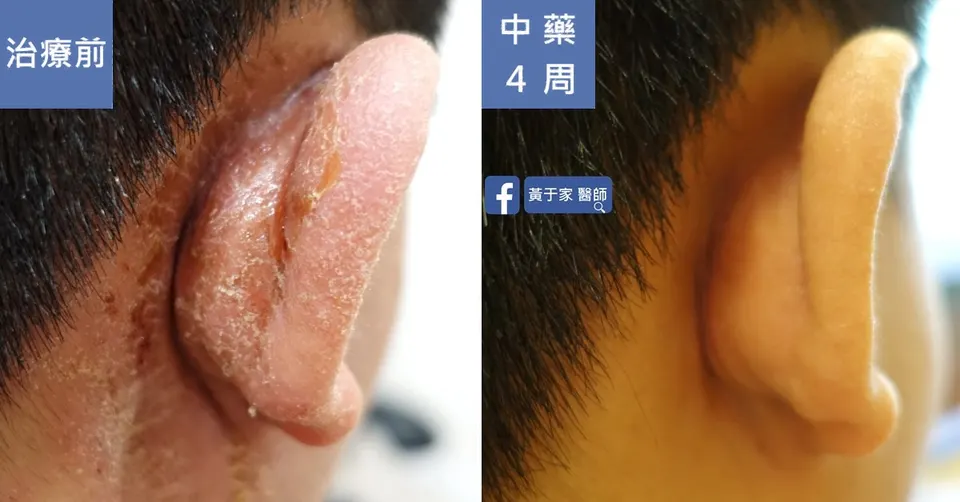 濕疹，治療前後皮膚外觀比對（2）