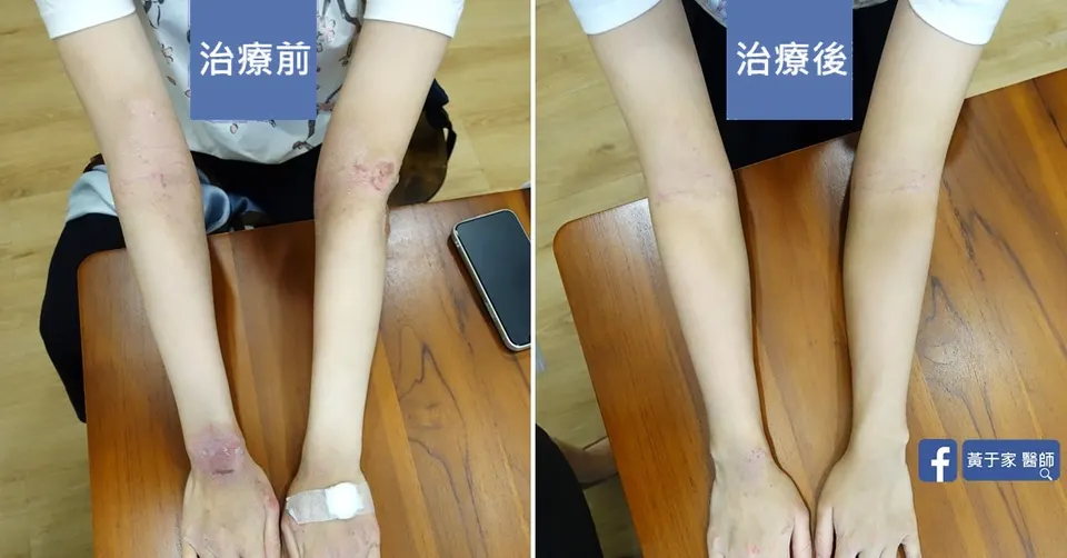 異位性皮膚炎，治療前後皮膚外觀比對（2）
