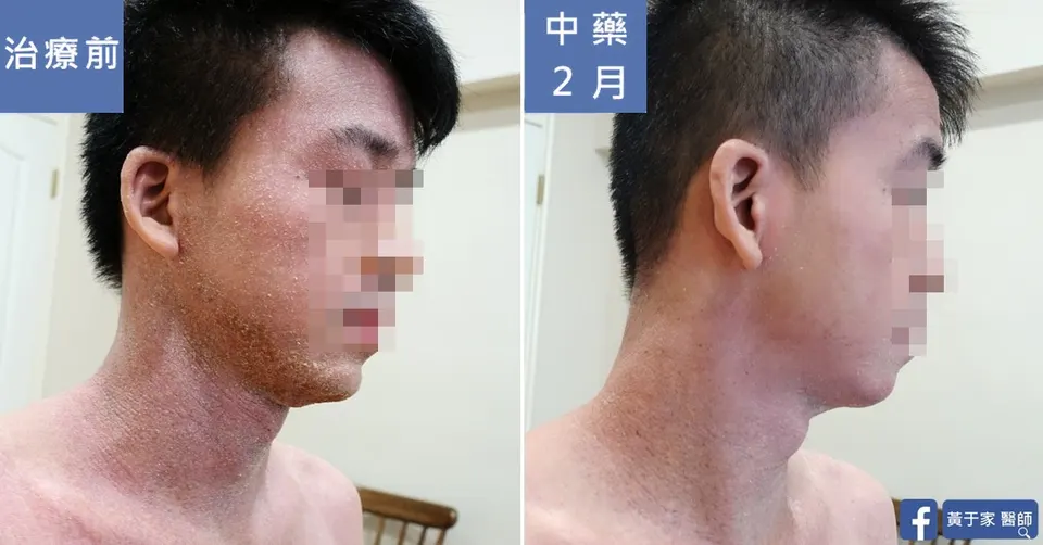 同一位患者臉部與頸部側面的比對,左標示「治療前」下巴與脖子泛紅脫屑,右標示「中藥 2 月」