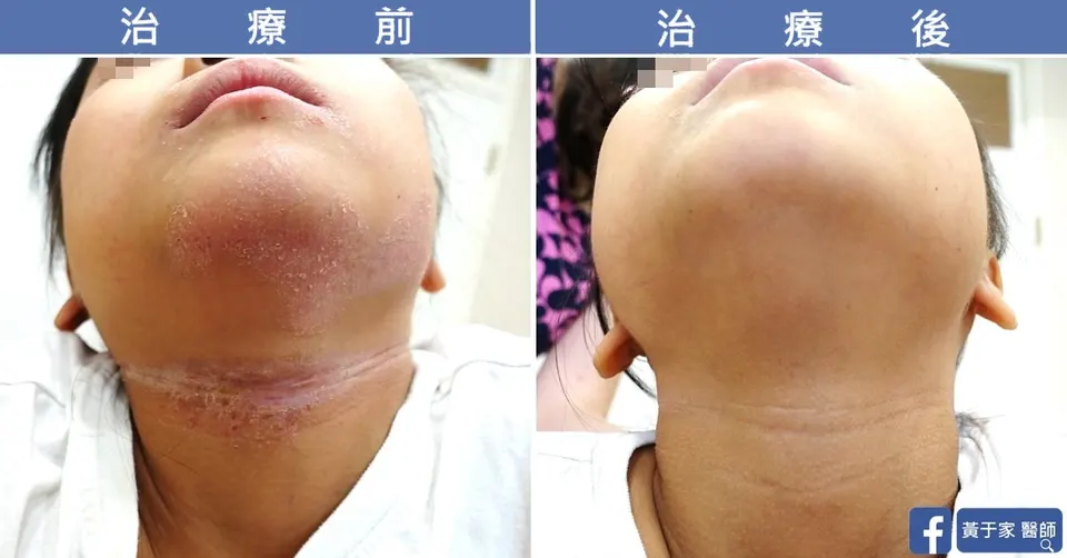 兒童施打杜避炎後下巴與頸部紅疹，治療前後對照