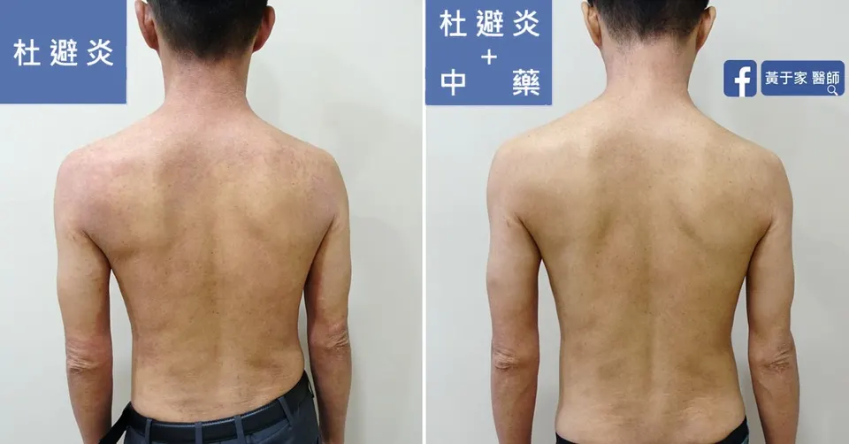 同一位患者背部的比對，左標示「杜避炎」，右標示「杜避炎＋中藥」