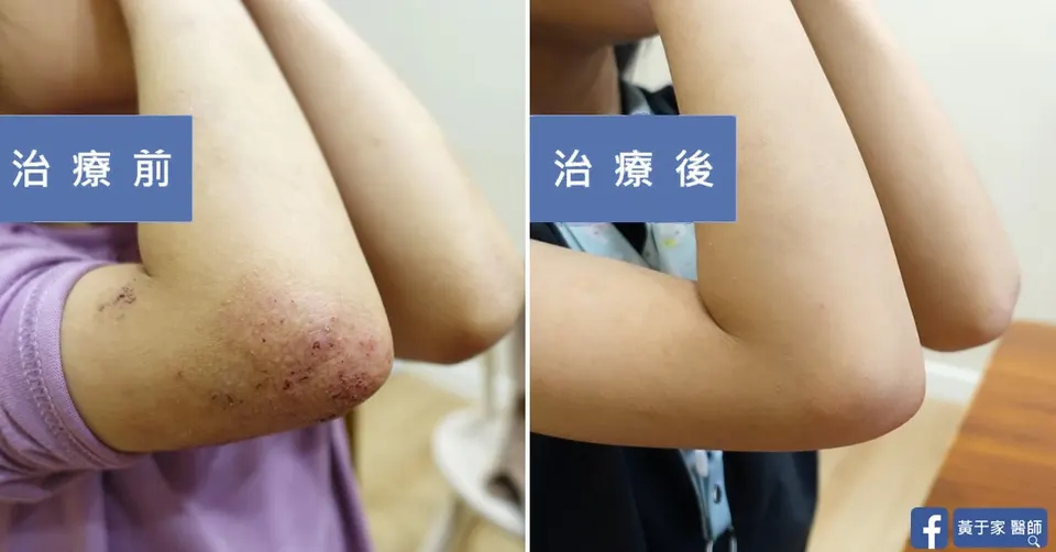 同一位患者手肘外側的比對，左標示「治療前」手肘布滿抓破的紅疹，右標示「治療後」