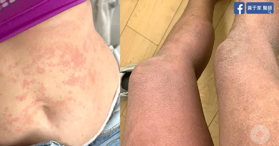 類固醇戒斷患者腹部紅疹與雙腿皮膚粗糙暗沉