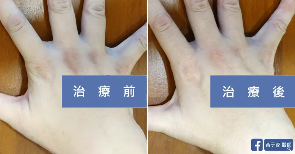 皮肌炎，治療前後皮膚外觀比對（2）
