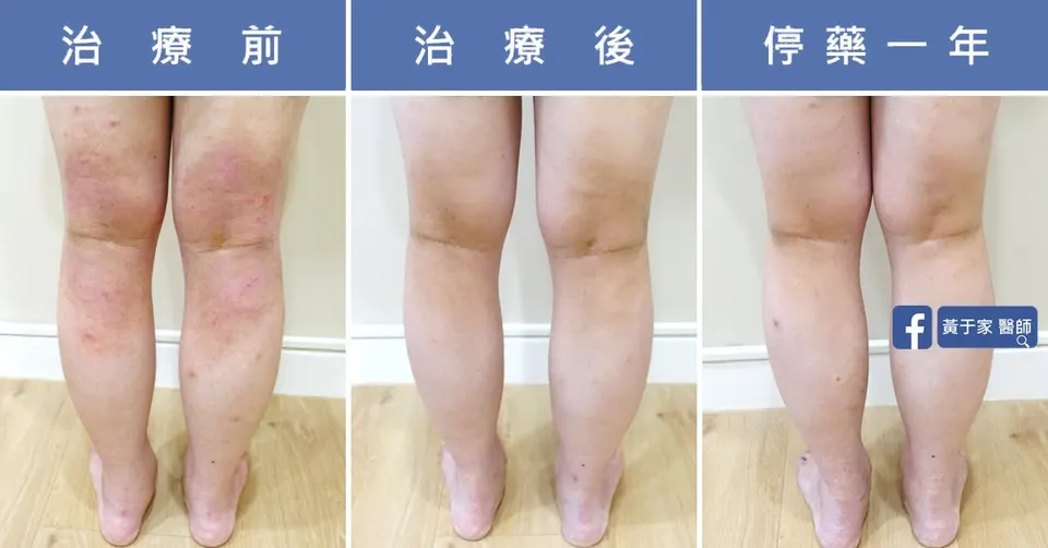 同一位患者雙腿背面的三張並排照片,依序標示「治療前」膝窩泛紅、「治療後」、「停藥一年」