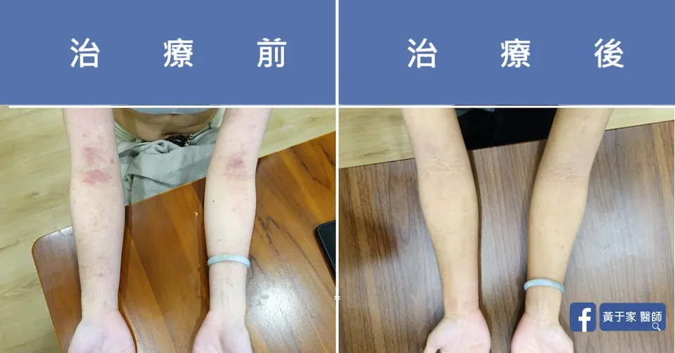 異位性皮膚炎，治療前後皮膚外觀比對（2）