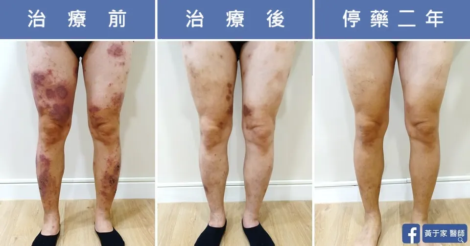 患者雙腿治療前、治療後與停藥二年三格對照